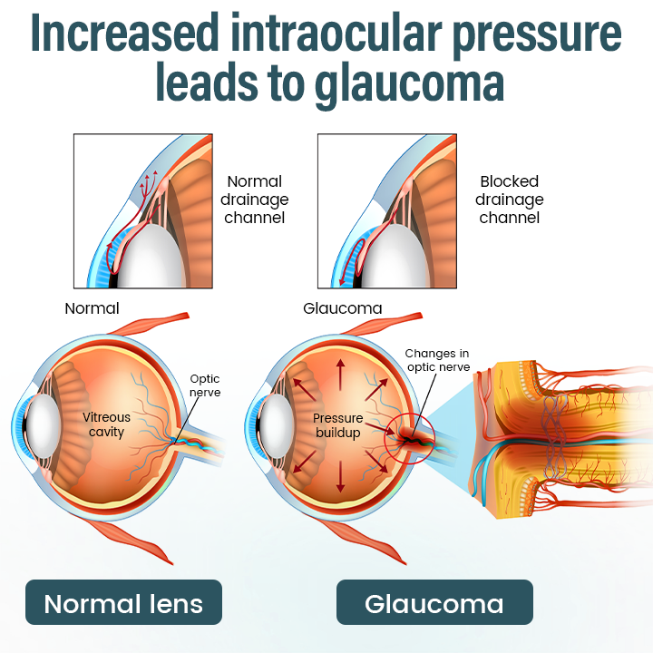 OptiFusion Nano Eye Drops Serum —Nano Technology Restores Clear Vision,  No Glasses, No Surgery