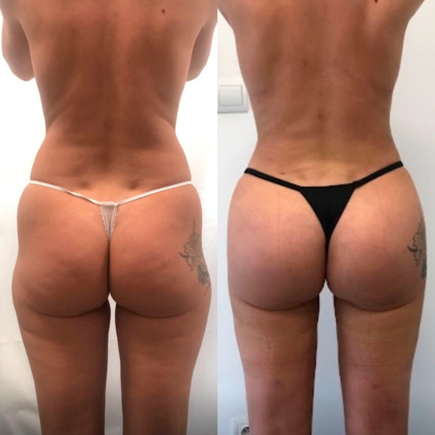 Curvessa Micro-Needle Sculpting Patches